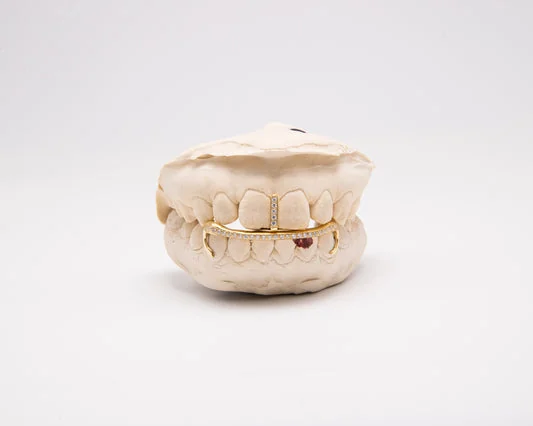 Gold opal smile jewelry on a dental model.